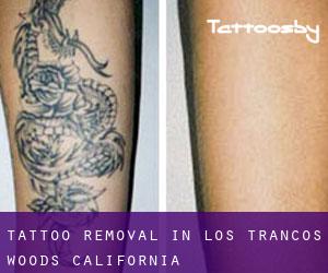 Tattoo Removal in Los Trancos Woods (California)