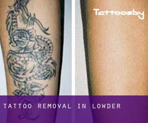 Tattoo Removal in Lowder