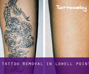 Tattoo Removal in Lowell Point