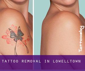 Tattoo Removal in Lowelltown