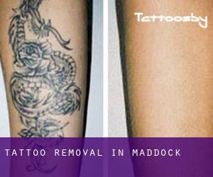 Tattoo Removal in Maddock