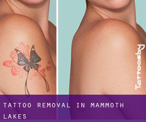 Tattoo Removal in Mammoth Lakes
