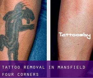 Tattoo Removal in Mansfield Four Corners