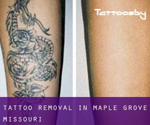 Tattoo Removal in Maple Grove (Missouri)