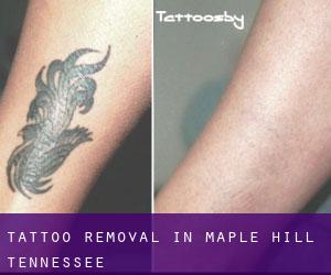 Tattoo Removal in Maple Hill (Tennessee)