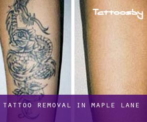 Tattoo Removal in Maple Lane