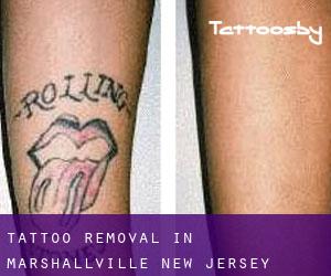 Tattoo Removal in Marshallville (New Jersey)