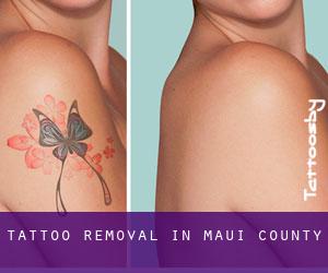 Tattoo Removal in Maui County