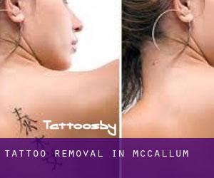 Tattoo Removal in McCallum