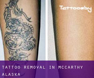 Tattoo Removal in McCarthy (Alaska)