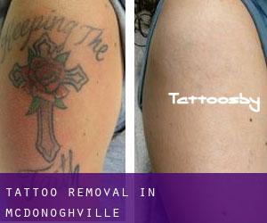 Tattoo Removal in McDonoghville