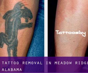 Tattoo Removal in Meadow Ridge (Alabama)