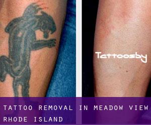 Tattoo Removal in Meadow View (Rhode Island)