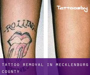Tattoo Removal in Mecklenburg County