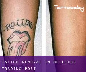 Tattoo Removal in Mellicks Trading Post