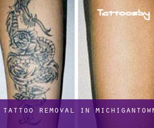 Tattoo Removal in Michigantown