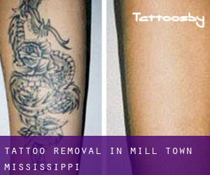 Tattoo Removal in Mill Town (Mississippi)