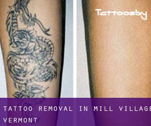 Tattoo Removal in Mill Village (Vermont)