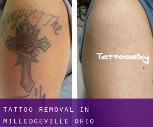 Tattoo Removal in Milledgeville (Ohio)