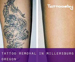 Tattoo Removal in Millersburg (Oregon)