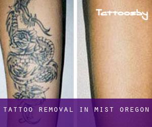 Tattoo Removal in Mist (Oregon)