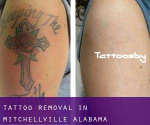 Tattoo Removal in Mitchellville (Alabama)