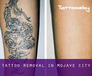 Tattoo Removal in Mojave City
