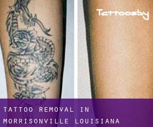Tattoo Removal in Morrisonville (Louisiana)