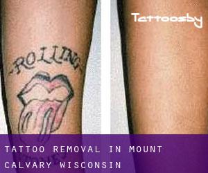 Tattoo Removal in Mount Calvary (Wisconsin)