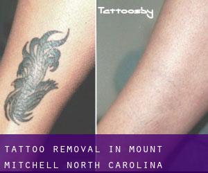 Tattoo Removal in Mount Mitchell (North Carolina)