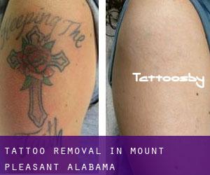 Tattoo Removal in Mount Pleasant (Alabama)