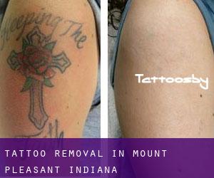 Tattoo Removal in Mount Pleasant (Indiana)