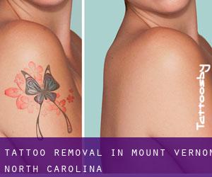 Tattoo Removal in Mount Vernon (North Carolina)
