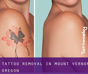 Tattoo Removal in Mount Vernon (Oregon)