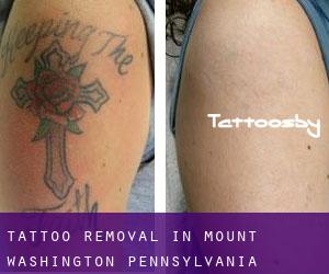 Tattoo Removal in Mount Washington (Pennsylvania)