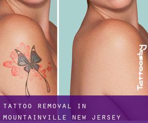 Tattoo Removal in Mountainville (New Jersey)