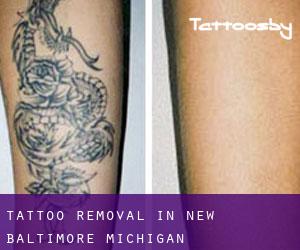 Tattoo Removal in New Baltimore (Michigan)