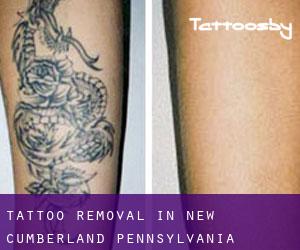 Tattoo Removal in New Cumberland (Pennsylvania)