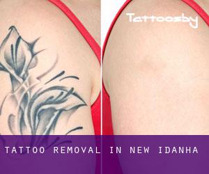 Tattoo Removal in New Idanha