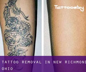 Tattoo Removal in New Richmond (Ohio)