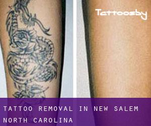 Tattoo Removal in New Salem (North Carolina)