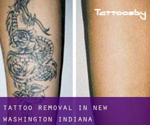 Tattoo Removal in New Washington (Indiana)