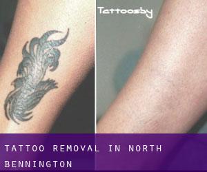 Tattoo Removal in North Bennington