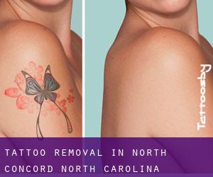 Tattoo Removal in North Concord (North Carolina)