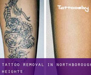 Tattoo Removal in Northborough Heights