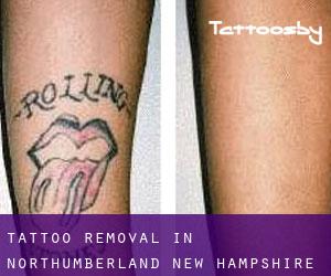 Tattoo Removal in Northumberland (New Hampshire)
