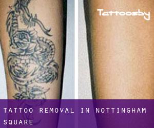 Tattoo Removal in Nottingham Square