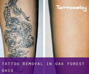 Tattoo Removal in Oak Forest (Ohio)