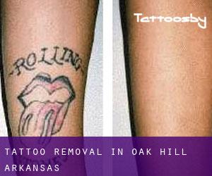 Tattoo Removal in Oak Hill (Arkansas)