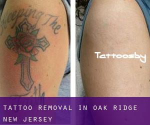 Tattoo Removal in Oak Ridge (New Jersey)